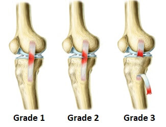 sprained knee