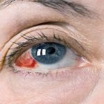Stroke in the Eye Causes, Symptoms, and Treatment stroke in eye