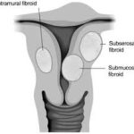 Subserosal Fibroids: Causes, Symptoms, and Treatment subserosal fibroid