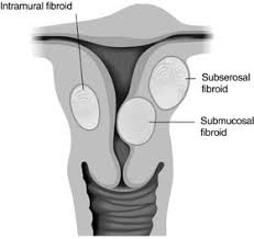 subserosal fibroid