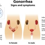The Threat of Super Gonorrhea What You Need to Know super gonorrhea