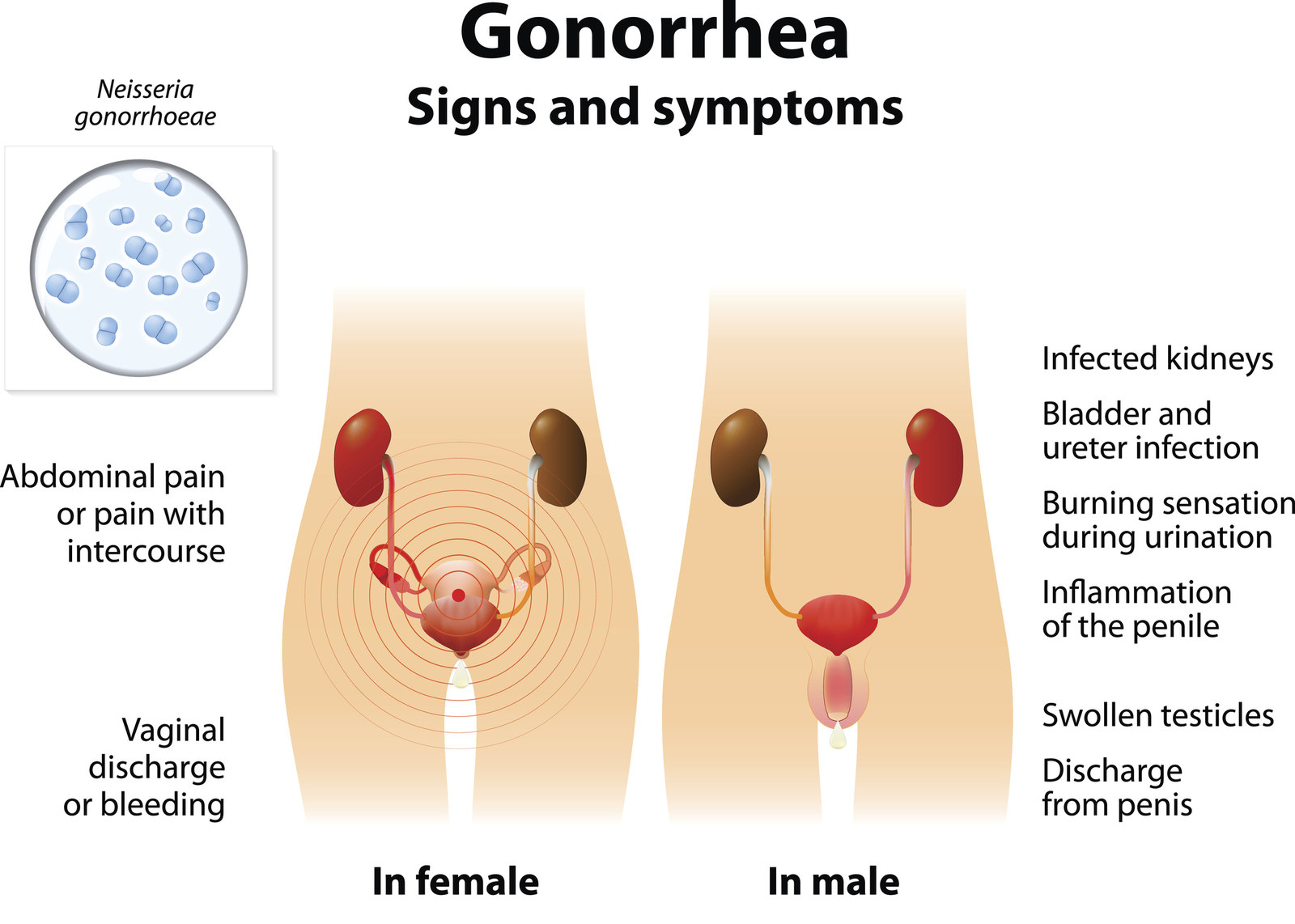 super gonorrhea