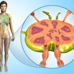 The Connection Swollen Lymph Nodes and Cancer swollen lymph nodes cancer