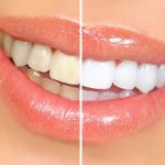 Brighten Your Smile with Professional Teeth Whitening Services teeth whitening service