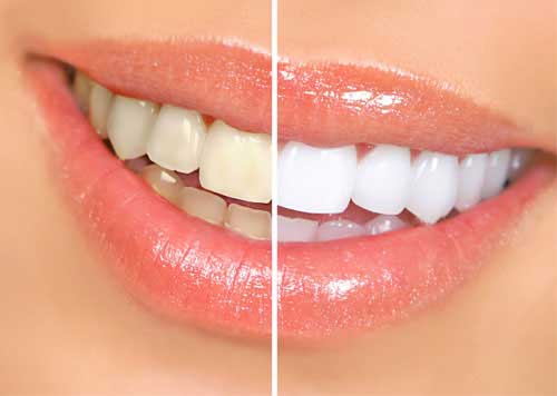 teeth whitening service
