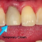 Temporary Crown Your Guide to Dental Restorations temporary crown