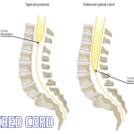 Demystifying Tethered Cord Syndrome: Causes, Symptoms, and Treatment tethered cord syndrome