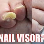 Thick Toenails Causes, Treatments, and Prevention thick toenails