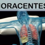 Thoracentesis: A Closer Look at the Thoracentesis Procedure thoracentesis procedure