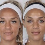 Your Skin with Thread Lift A Non-Surgical Facelift Option thread lift