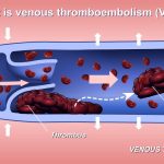 Thrombosis vs. Embolism the Critical Differences thrombosis vs embolism