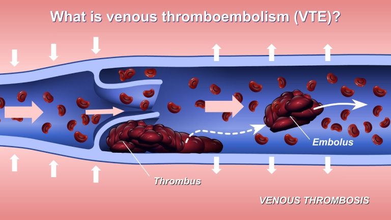 Thrombosis vs. Embolism the Critical Differences