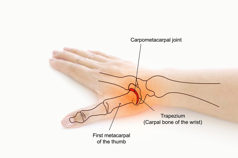 Thumb Arthritis Causes, Symptoms, and Treatment