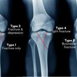Tibial Plateau Fracture Causes, Symptoms, and Treatment tibial plateau fracture