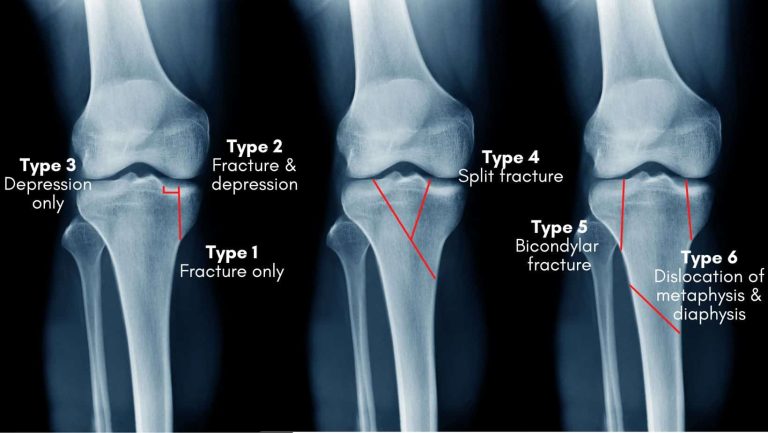 tibial-plateau-fracture-causes-symptoms-and-treatment