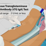 Demystifying Tissue Transglutaminase IgA: Understanding Its Role tissue transglutaminase iga