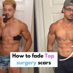 Transformative Changes the World of Top Surgery top surgery