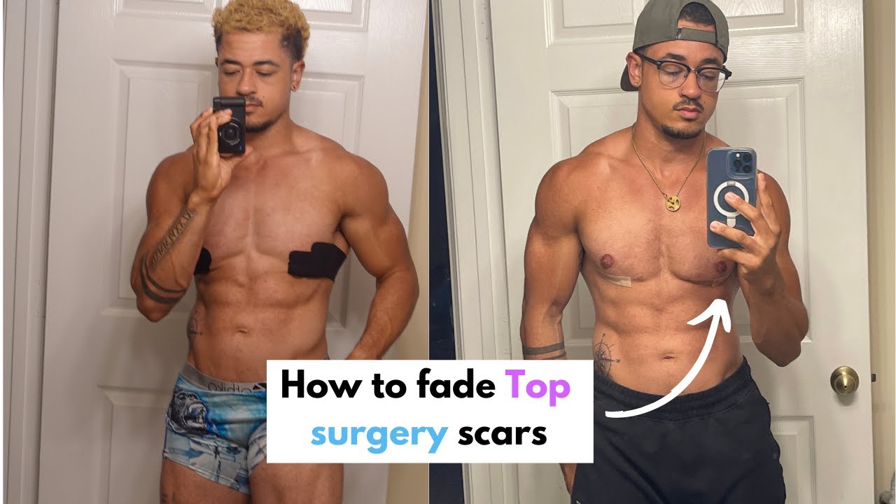 top surgery