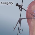 Recovering Strong Everything You Need to Know About Torn Meniscus Surgery torn meniscus surgery