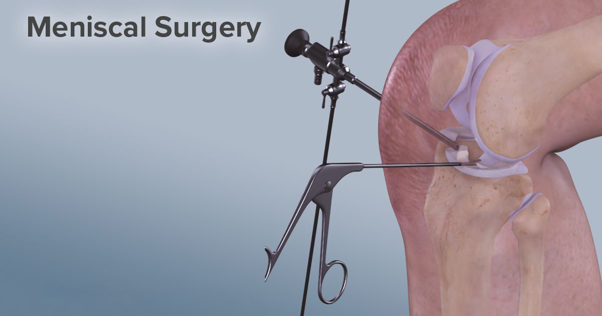 torn meniscus surgery