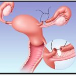 The Possibilities Tubal Ligation Reversal for a Second Chance at Parenthood tubal ligation reversal