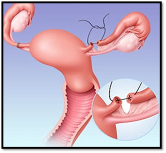 tubal ligation reversal