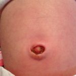 Umbilical Granuloma: Causes, Treatment, and Prevention umbilical granuloma