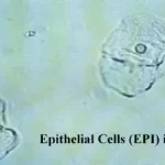 Demystifying Urine Squamous Epithelial Cells: Insights and Interpretations urine squamous epithelial cells