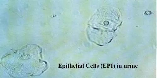 urine squamous epithelial cells