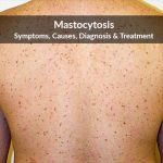 Urticaria Pigmentosa: Causes, Symptoms, and Treatment urticaria pigmentosa