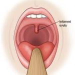 Demystifying Uvulitis: Causes, Symptoms, and Treatmen uvulitis