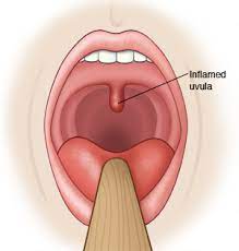 uvulitis