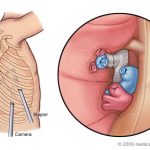 The Benefits of VATS Procedure A Minimally Invasive Marvel vats procedure