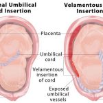 Velamentous Cord Insertion The Hidden Pregnancy Risk velamentous cord insertion