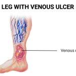 Venous Stasis Ulcer Causes, Symptoms, and Treatment venous stasis ulcer