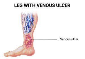 Venous Stasis Ulcer Causes, Symptoms, and Treatment