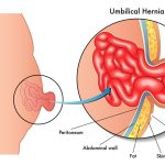 Ventral Hernia Causes, Symptoms, and Treatment ventral hernia