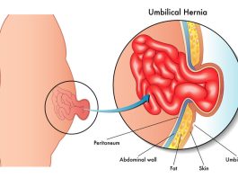 ventral hernia