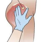 Mastering the Ventrogluteal Injection Technique: Precision and Safety ventrogluteal injection