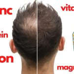 Vitamin Deficiency That Causes Hair Loss vitamin deficiency that causes hair loss