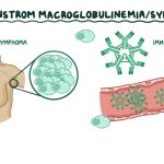 Waldenstrom Macroglobulinemia Causes, Symptoms, and Treatment waldenstrom macroglobulinemia