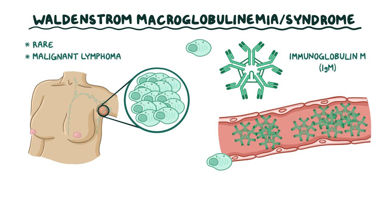 waldenstrom macroglobulinemia