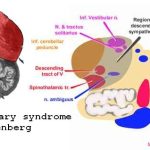 Wallenberg Syndrome Symptoms, Causes, and Treatment wallenberg syndrome