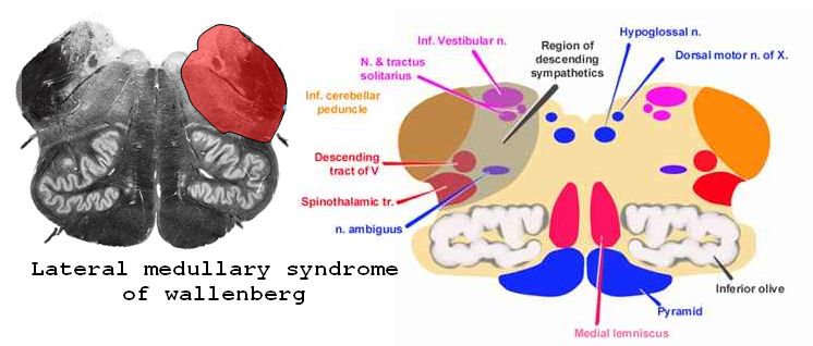 wallenberg syndrome