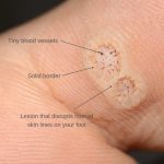 Warts on Feet Causes, Treatment, and Prevention warts on feet