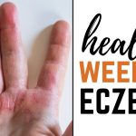Dealing with Weeping Eczema: Causes, Symptoms, and Solutions weeping eczema