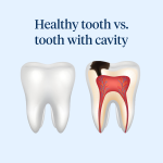 Deciphering Dental Secrets: What Do Cavities Look Like and How to Identify Them what do cavities look like