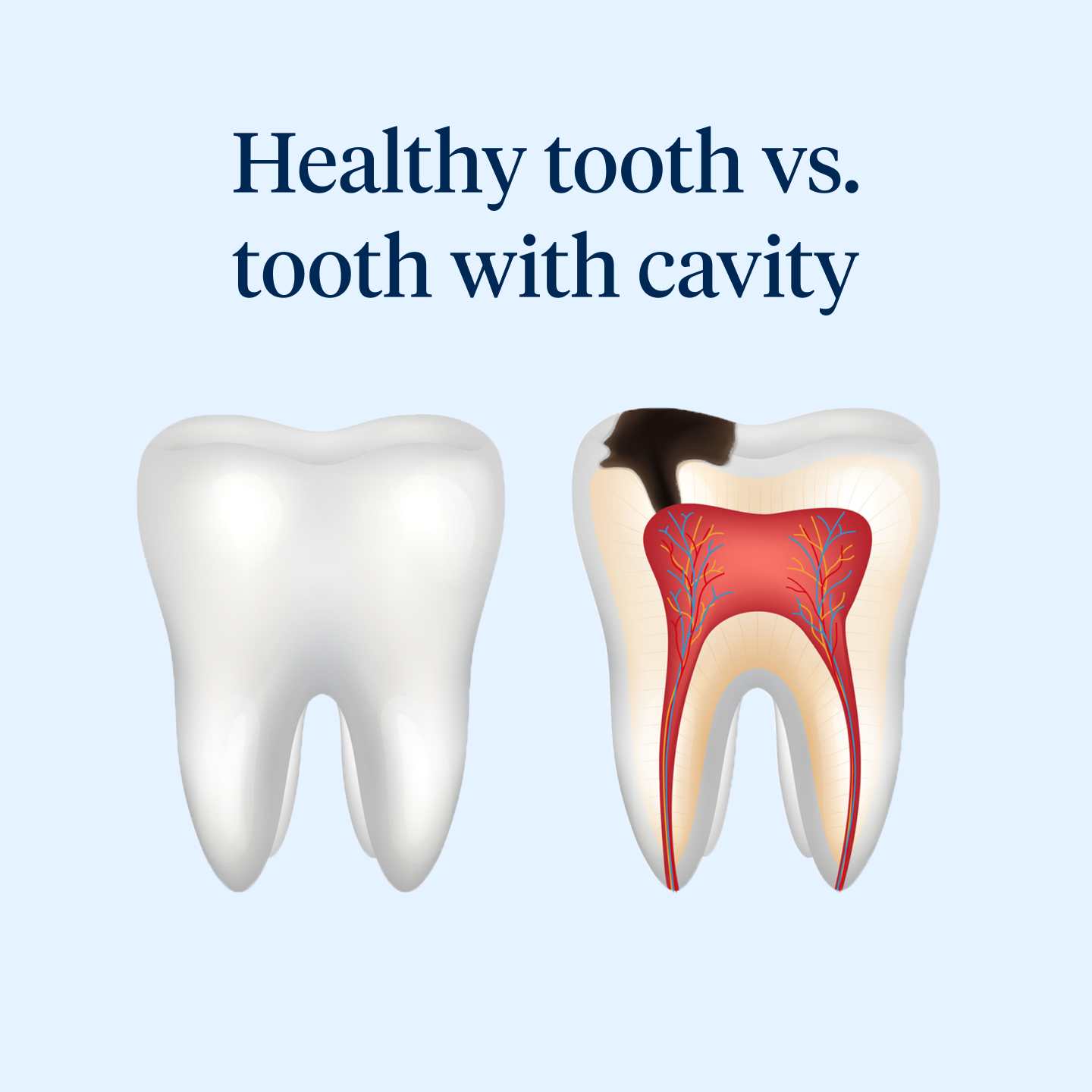 what do cavities look like