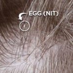 Demystifying Lice Eggs: What Do They Look Like? what do lice eggs look like