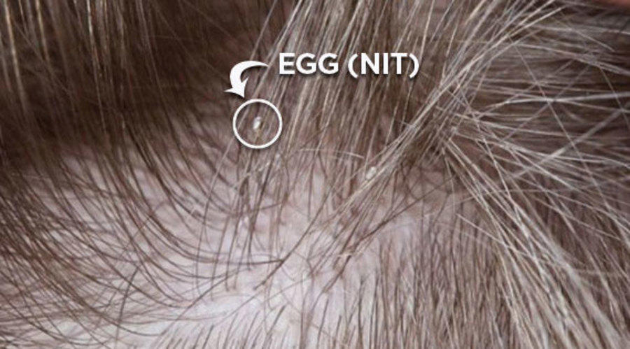 Demystifying Lice Eggs: What Do They Look Like?